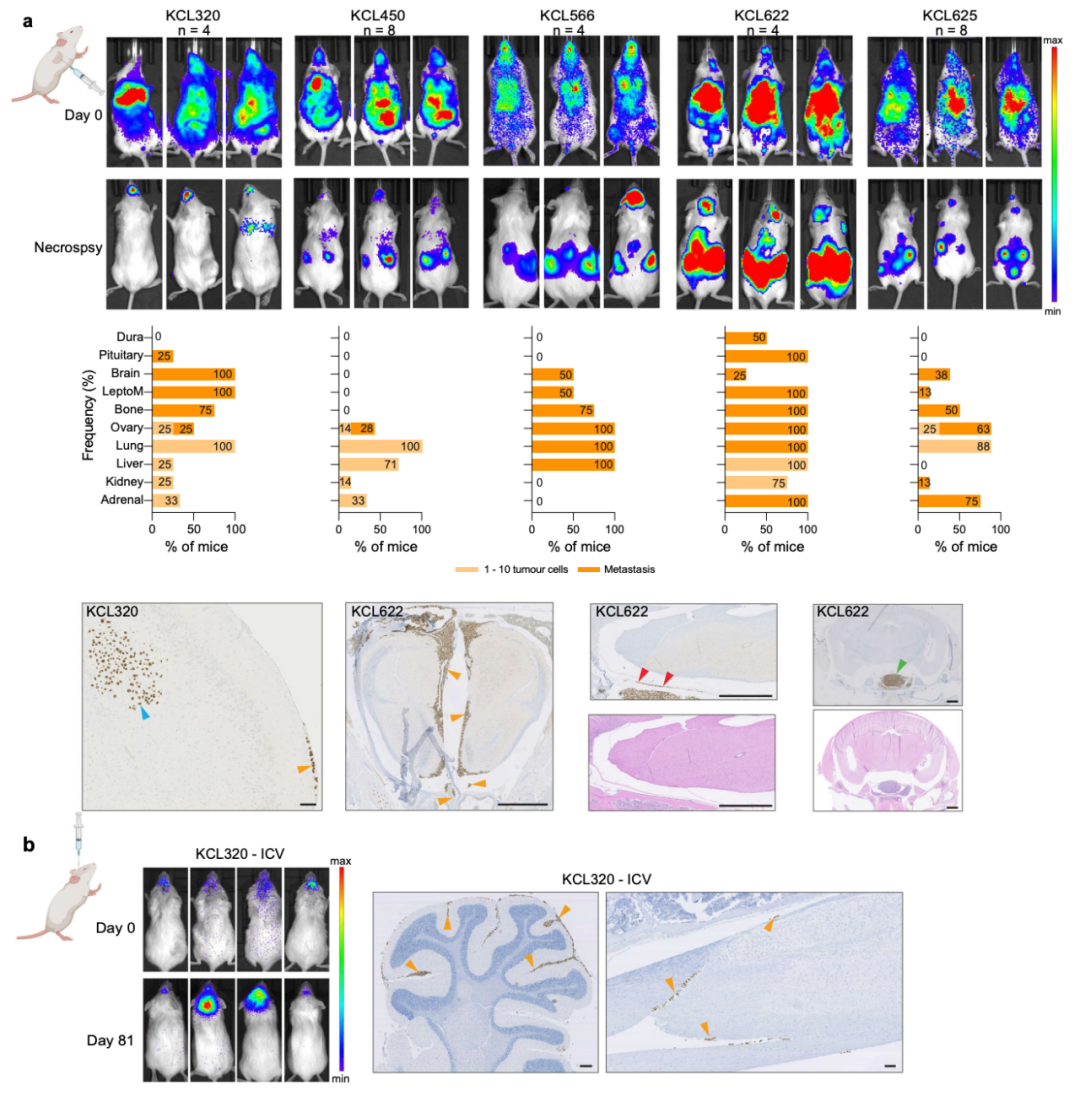 Nature子刊：患者來源的類器官，為乳腺癌腦轉移帶來新見解